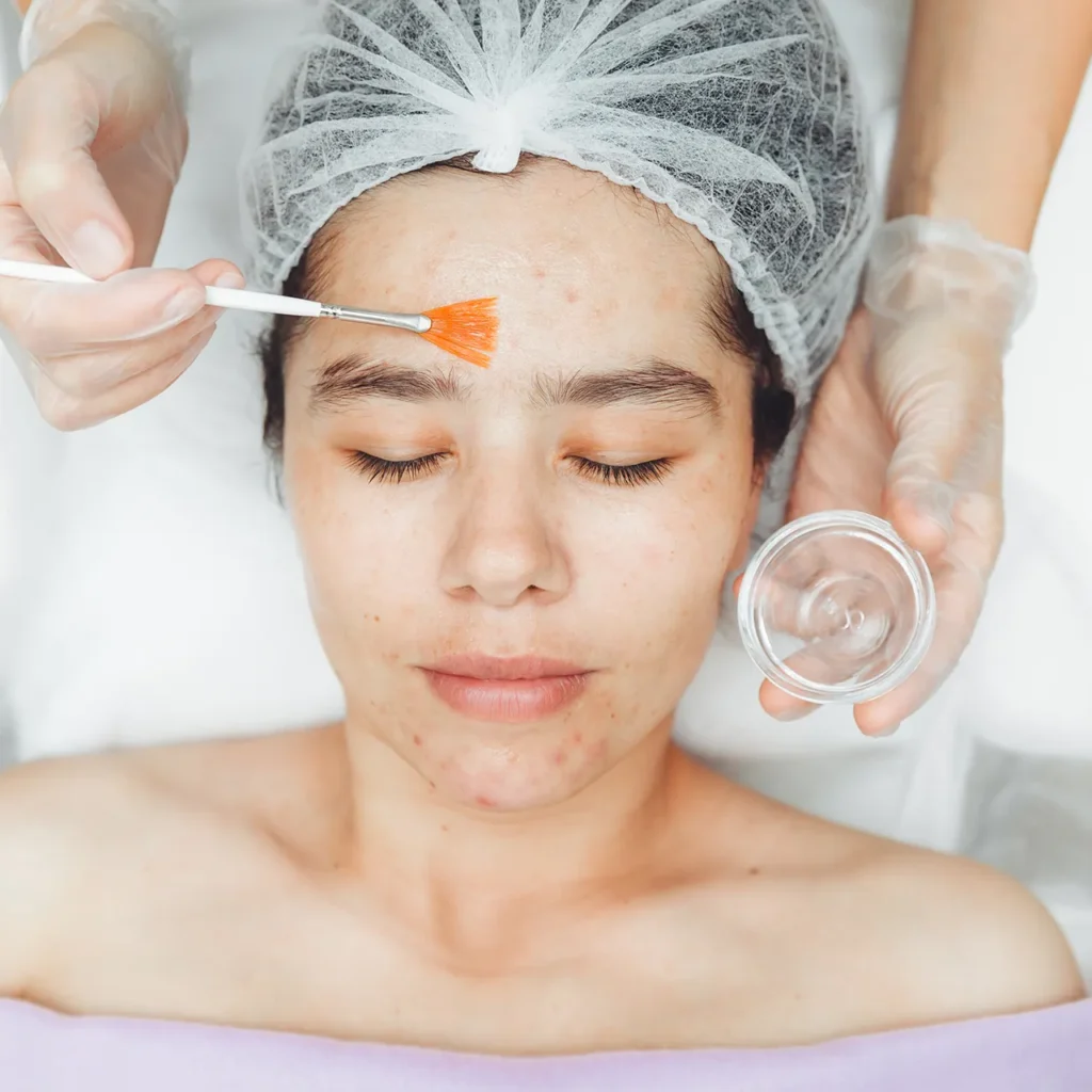 Facial Acne